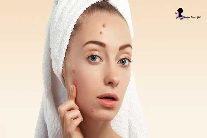علت جوش صورت چیست؟ + راه های درمان