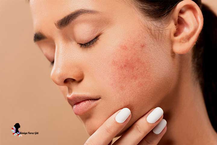 علت جوش صورت چیست؟